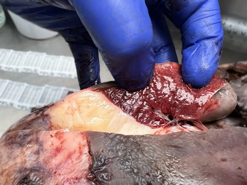 Line between tumor and spleen